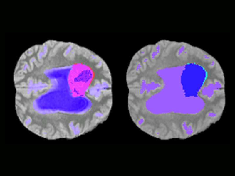 AI Brain Tumour Segmentation portfolio preview image